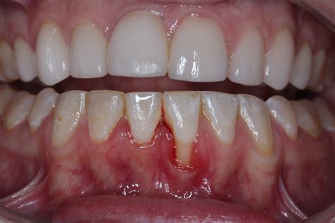 A Case Study On How To Fix Gum Recession