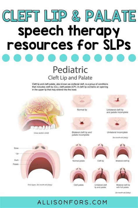 Cleft Lip And Palate Speech Therapy Intervention Allison Fors In 2021 Speech Therapy