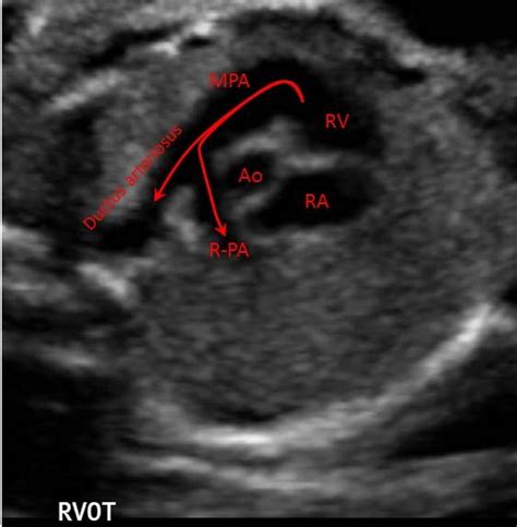 Fetal Echocardiograph Views Image