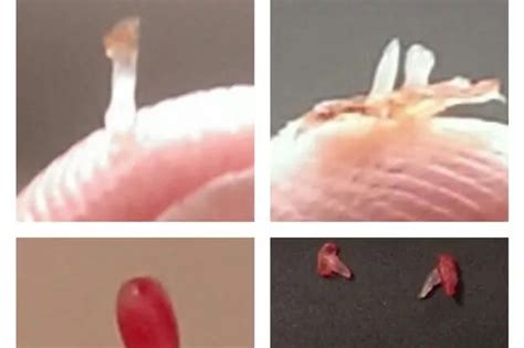 Look Gruesome Gallery Of Weird Objects Pulled From Mans Skin