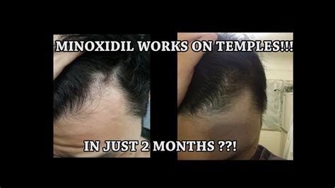 minoxidil work  temples    months youtube