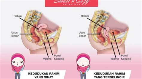 Antara kaedah utama bagaimana untuk selamat ketika bahkan di malaysia ini sudah ramai ibu mengandung di luar rahim yang dapat diselamatkan ibu dan bayi. Wanita Perlu Tahu Cara Sebenar Kesan Peranakan Jatuh ...