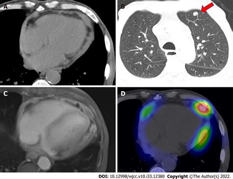 Primary Malignant Pericardial Mesothelioma With Difficult Antemortem