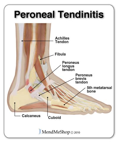 This tendon can get irritated from overuse, muscle weakness and muscle tightness, causing tenderness and pain. Tendonitis - Sharon Karam