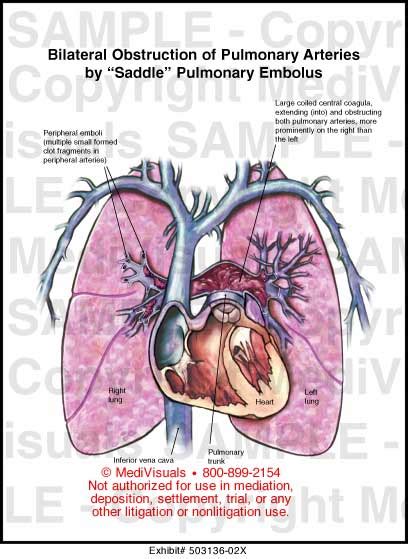 Medivisuals Bilateral Obstruction Of Pulmonary Arteries By Saddle
