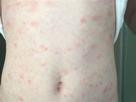 Images Show Eight Types Of Rash That Could Be Symptom Of Coronavirus