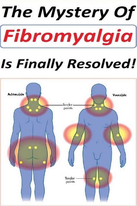 Fibromyalgia Pressure Points Chart