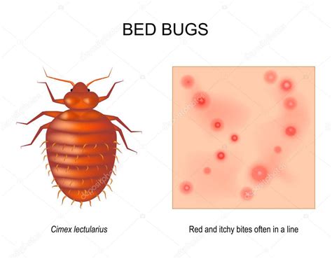 Chinche Cama Hembra Adulta De Cimex Lectularius Primer Plano De La Piel Con Picaduras Rojas Y