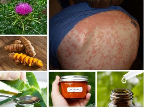 20 Remedios Caseros Para Tratar Los Síntomas De La Psoriasis En Vida