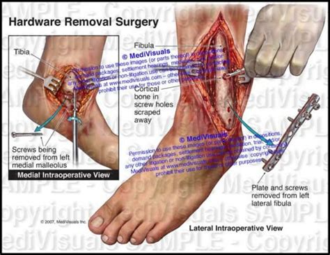 Hardware Removal Surgery Of Left Ankle Medivisuals Inc