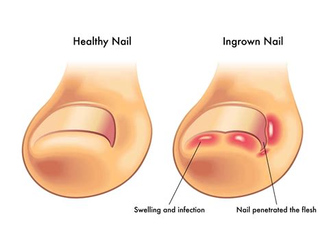 Ingrown Toenails Do I Need Surgery A Step Ahead Foot Ankle Care