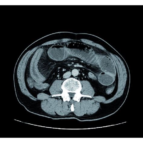 Contrast Enhanced Abdominal Ct Findings Demonstrated Small Intestinal