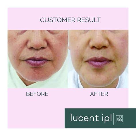Ipl Photofacial And Skin Rejuvenation