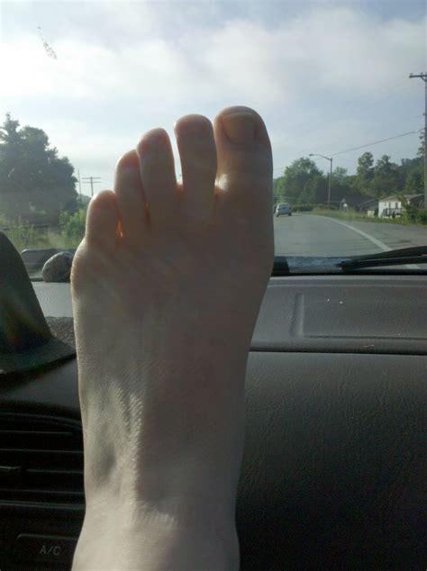 MoveMe: Bunions, Treatments, Surgeries...Oh My! The Story of My Quadruple Bunionectomy