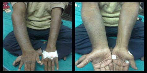 Photograph Showing Uniform Swelling Of Right Upper Limb Download