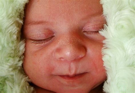 White Bumps On Face Not Milia Baby What Milia Are And How To Get Rid