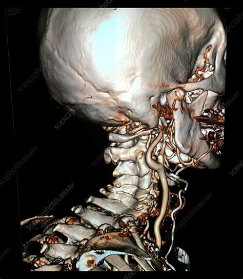 Common Carotid Artery Bifurcation 3D CTA Stock Image C039 3928