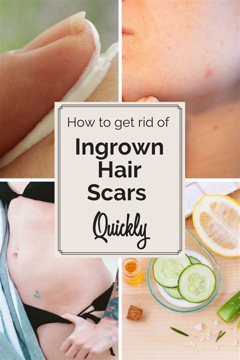 How Do I Get Rid Of An Ingrown Hair Fast Mastery Wiki