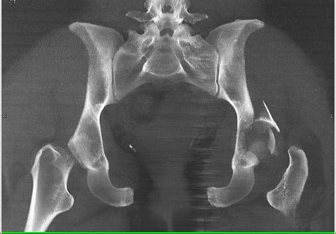 Acetabular Fracture With Hip Dislocation And Reduction