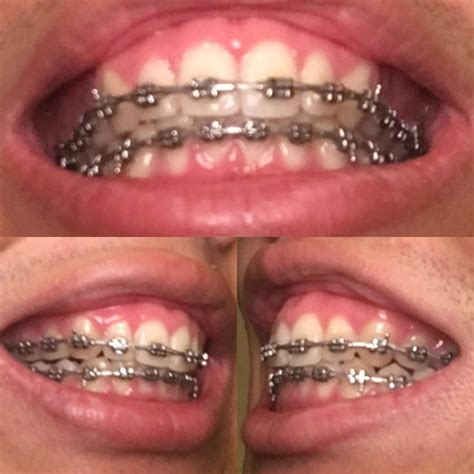 This is something that braces veterans forget. Do my teeth look ready? Getting my braces off in July : braces