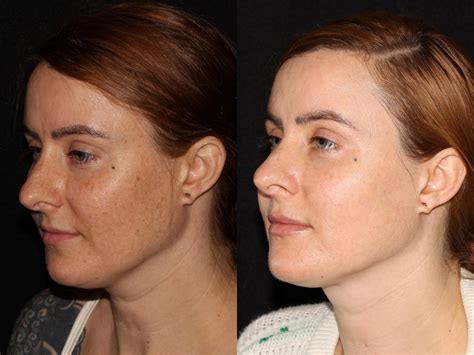 Bbl Photofacial Before And After Pictures Case 6 Chico Yuba City