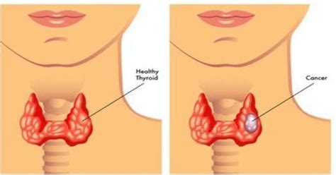 Most Cancers Signs And Symptoms Of The Throat