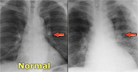 Vascular Congestion Chest X Ray