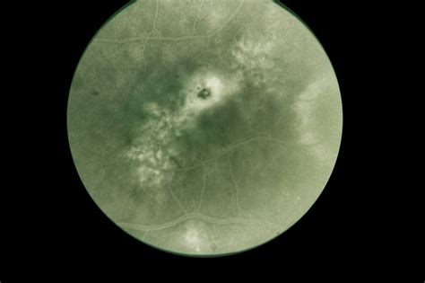 Presumed Ocular Histoplasmosis Syndrome Retina Image Bank