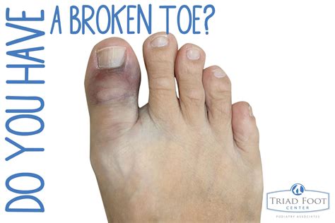 How Do You Know If Youve Got A Broken Toe Here Are Some Key Warning