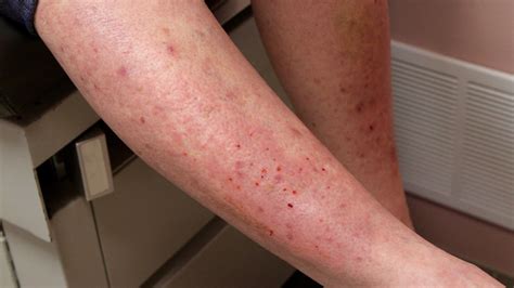 Bl Sdermatoser Dermatitis Herpetiformis Praktisk Medicin