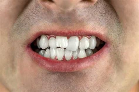 Dente Encavalado Conheça As Causas Consequências E O Tratamento