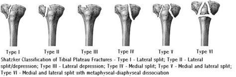 These fractures involve the articular surface of the tibia that is part of the knee joint. Distal Femur, Knee, and Tibial Plateau | Team Bone