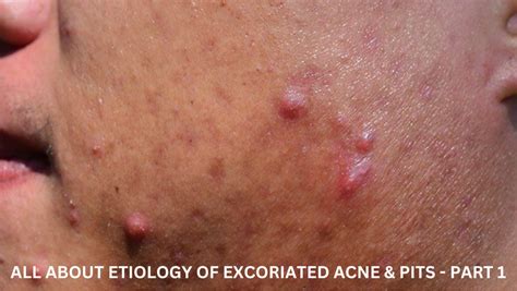 All About Etiology Of Excoriated Acne And Pits Part 1