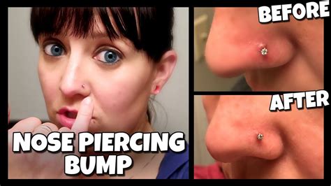 How To Get Rid Of A Nose Piercing Bump FAST Keloid How To With Kristin YouTube