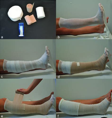 Compression Therapy In Patients With Venous Leg Ulcers Dissemond