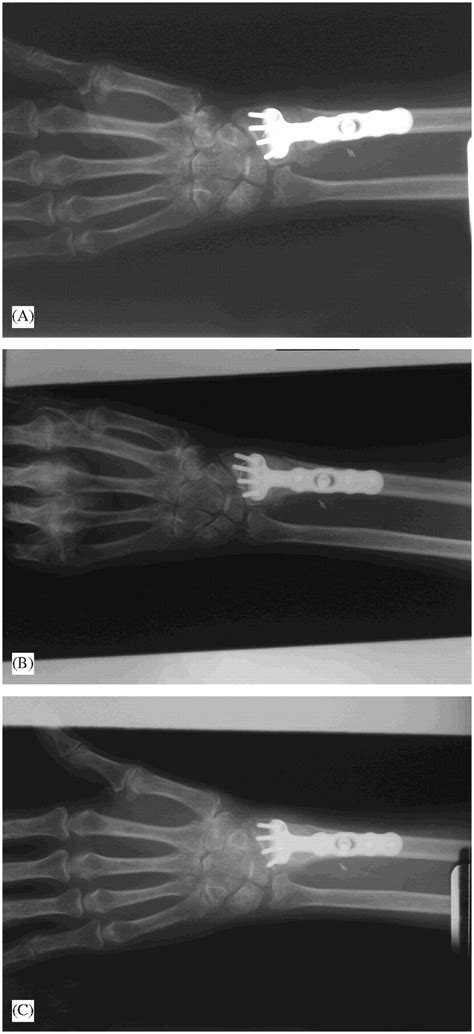 Immediate Mobilisation Following Corrective Osteotomy Of Distal Radius