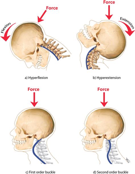 Mechanisms Of Cervical Spine Injury In Rugby Union Is It Premature To