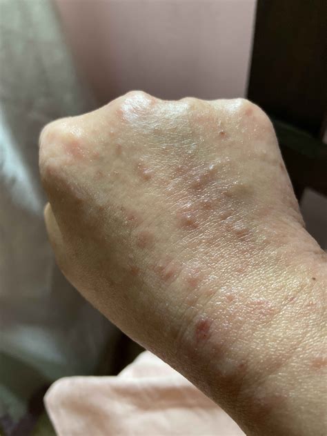 what do i do if i suffer from eczema and my hand and arm suddenly develop a lot of rashes
