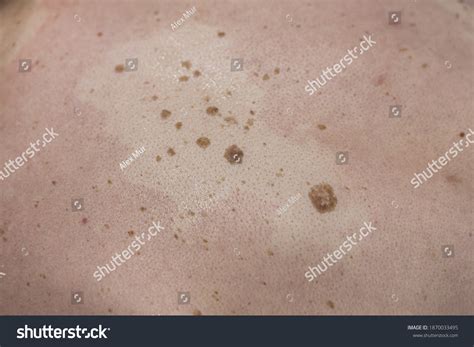 Seborrheic Keratosis On Human Skin Before Foto Stok 1870033495