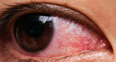 Causes Of Corneal Ulcer Pain Redness Light Sensitivity And Other