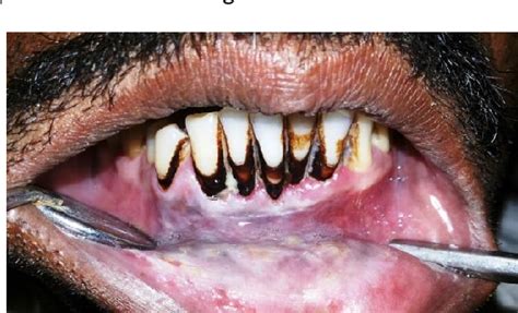 A Case Series Smokeless Tobacco Induced Oral Premalignant Lesions
