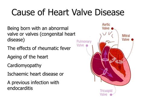 Valvular Heart Disease Causes