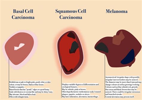 Main Type Of Skin Cancer Their Differences Histology And Prevention