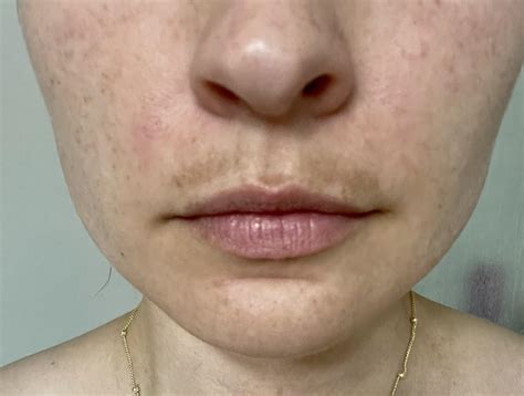 What Is A Melasma Mustache And How Do I Get Rid Of It Off