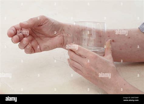 Meningitis Rash Glass Hi Res Stock Photography And Images Alamy