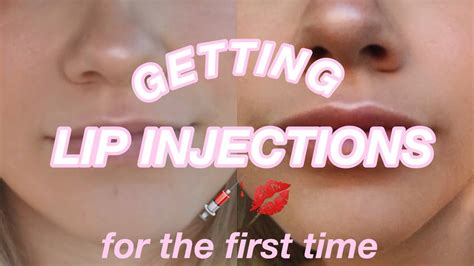 Getting Lip Injections The Truth About Lip Filler Youtube