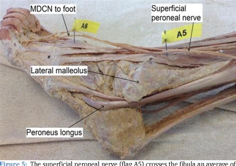 Figure 5 From Clinical Anatomy The Superficial Peroneal Nerve A Review