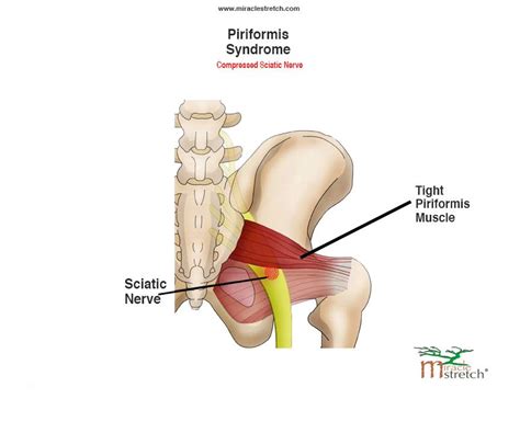 When something injures or puts pressure on the sciatic nerve, it can cause pain in the lower back that spreads to the hip, buttocks, and leg. A compressed sciatic nerve can cause low back, buttocks & leg pain. Get natural relief at http ...