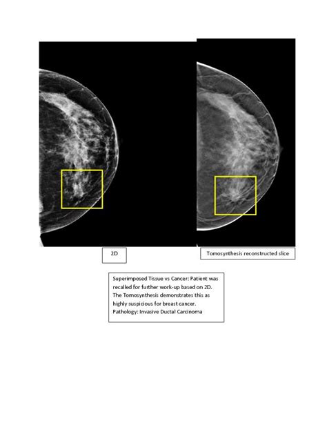 Groundbreaking Study Demonstrates The Benefits Of 3d Mammograms Ella