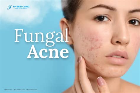 Penyebab Dan Cara Mengatasi Fungal Acne Fifi Skin Clinic